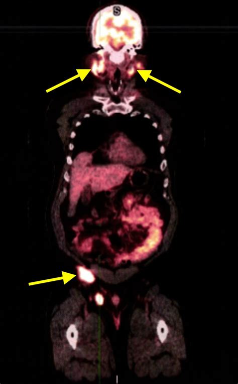 PET scan showing diffuse lymphoma involving both above and below the ...