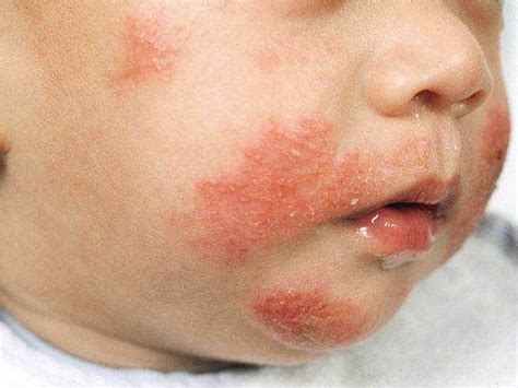 Atopic dermatitis in child pictures | Symptoms and pictures