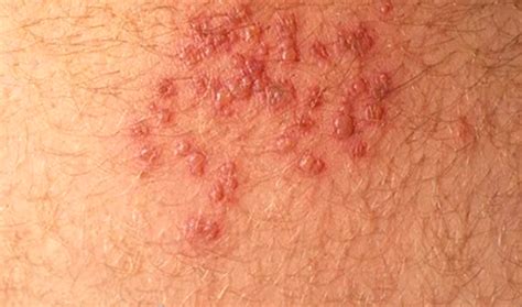 HIV Rash: Images, Symptoms, Location, and Treatment | HubPages