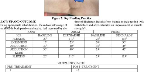 Figure 2 from EFFICACY OF DRY NEEDLING IN POST TOTAL KNEE REPLACEMENT ...