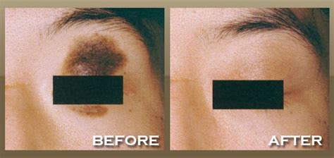 Skinpeccable | Mole Removal | Los Angeles