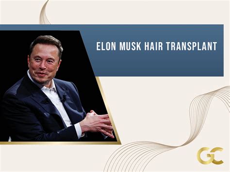 Elon Musk Hair Transplant - Gold City Best Hair Transplant Turkey