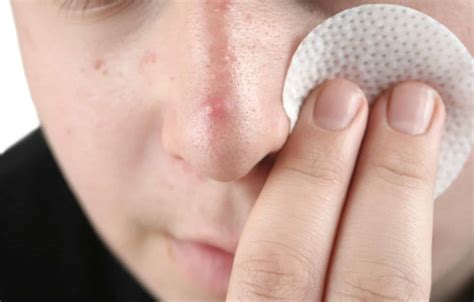 How To Prevent Pimples On Nose, According To Dermatologists! - Cureskin