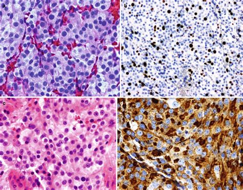 Atypical Pituitary Adenomas | Neupsy Key