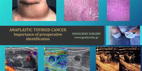 Anaplastic thyroid cancer - importance of preoperative diagnosis