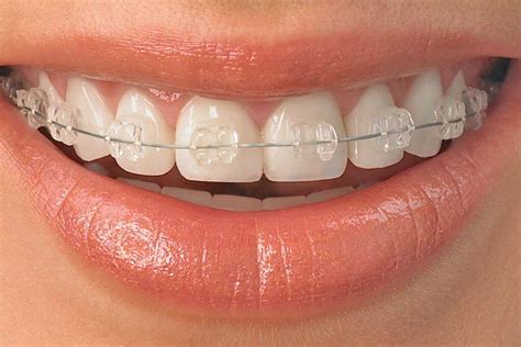 How Are Ceramic Braces Put On? Know if you're best candidate for this!