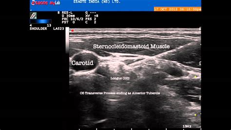 Ultrasound guided Stellate Ganglion for CRPS - YouTube