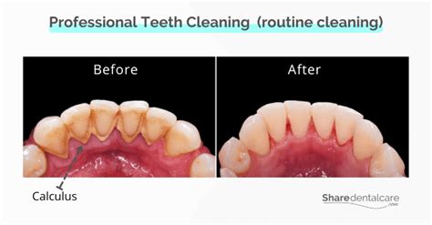 Heavy Calculus on Teeth - Share Dental Care