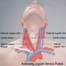 Image result for jugular vein distention | Medical school essentials ...