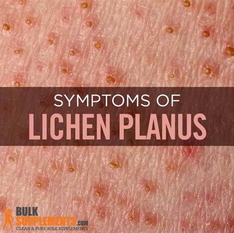 Lichen Planus. it's Time for Relief. Treatment for Rashes & Dental Pain