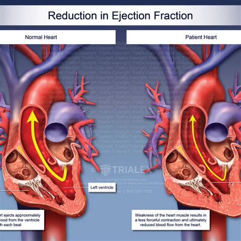 Reduction in Ejection Fraction - TrialExhibits Inc.