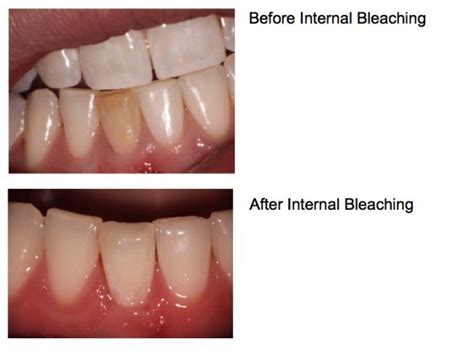 Internal Bleaching – Dana Point Endodontics | Daniel J. Boehne, DDS | Board Certified Endodontist