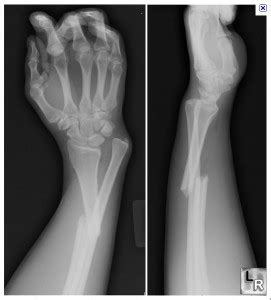 What are the complications of a fracture? - First Aid for Free