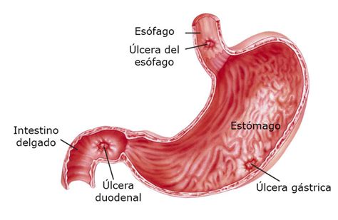 Úlcera: ¿Qué es? - Síntomas, causas y tratamiento