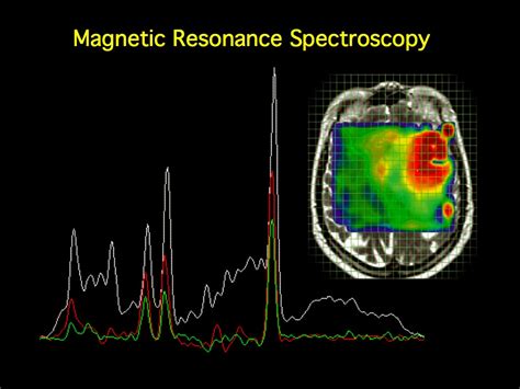 MRI BLOG: Magnetic Resonance Spectroscopy