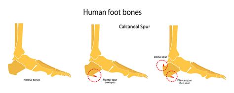 Human Foot Bones Plantar And Dorsal Spur Vector Illustration Stock ...