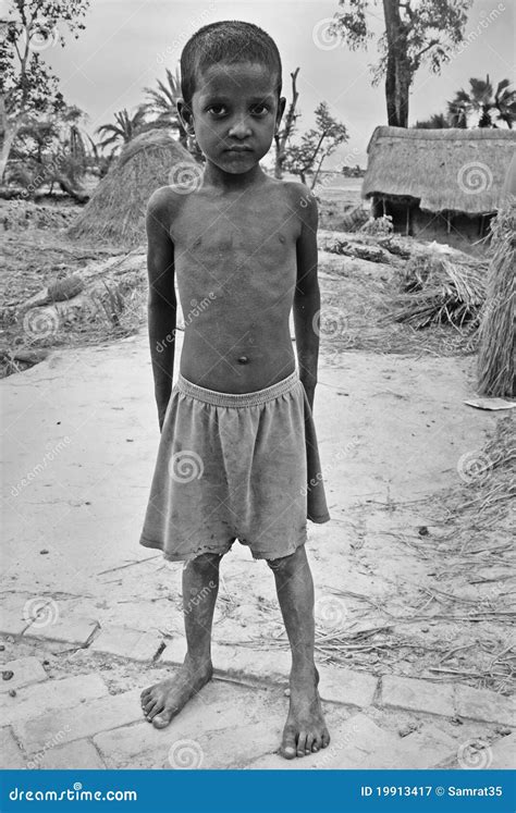 Malnourished Children in India Editorial Photography - Image of india ...