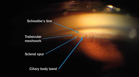 Plateau Iris Gonioscopy Heiko philippin figure 4. | Glaucoma | Pinterest | Africans, Irises and ...