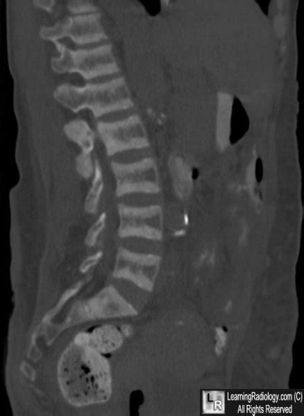 Learning Radiology - Renal Osteodystrophy, Rugger, Jersey, Spine ...