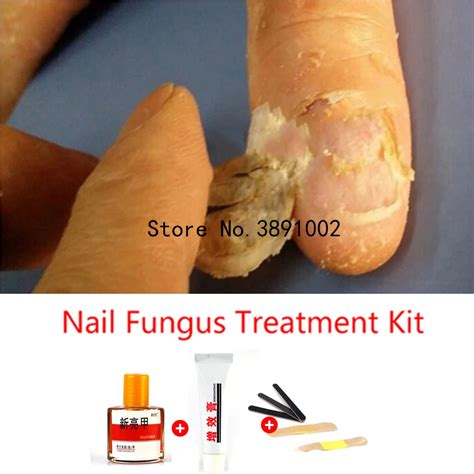 Herbal Fungal Nail Treatment Essence Toe Nail Finger Anti Fungus Infection Nail Treatment ...