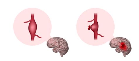 Aneurysm - Brain Foundation