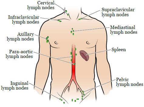 Para Aortic Lymph Node Cancer Treatment