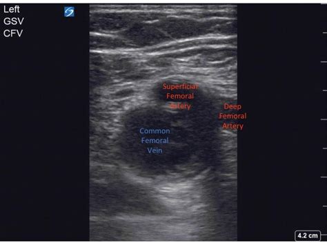 Ultrasound Case Series — ACMC EM