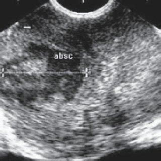 (PDF) Minimally-invasive management of prostatic abscess: The role of transrectal ultrasound