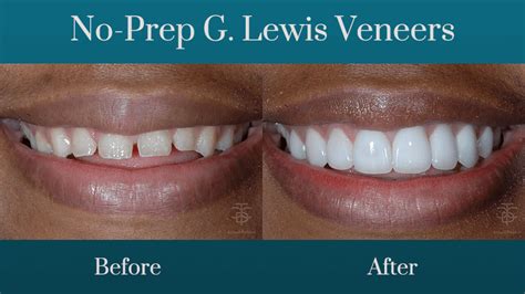 GOODBYE TRADITIONAL VENEERS - HELLO TO NO-PREP VENEERS!