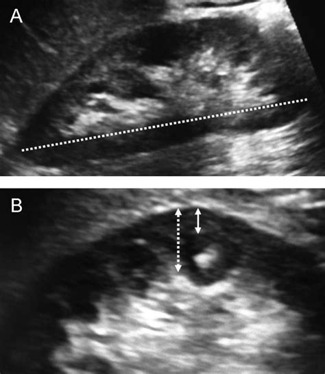 Representative ultrasound images of the kidney. A. Showing absolute ...