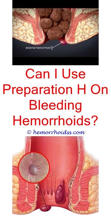 Can Aspirin Cause Hemorrhoids To Bleed? | Hemorrhoid remedies, Bleeding ...