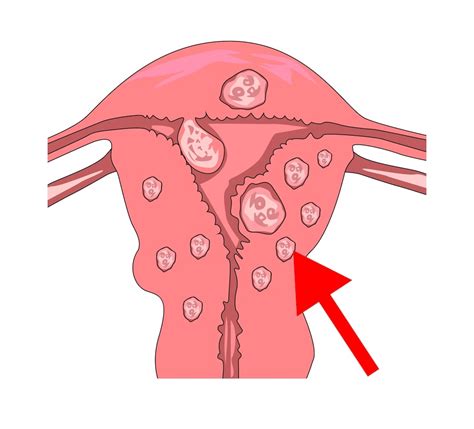 Myoma (Fibroid) — Causes, Symptoms, Treatment