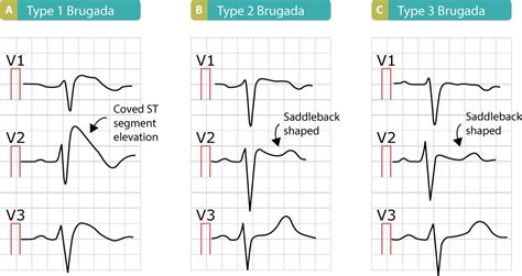 Brugada syndrome: ECG, clinical features and management – Cardiovascular Education