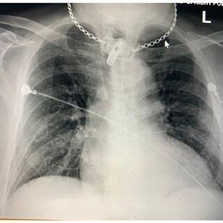 Chest X-ray AP view showing bibasilar opacities likely atelectasis and... | Download Scientific ...