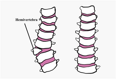 Hemivertebrae In Pugs Symptoms , Free Transparent Clipart - ClipartKey