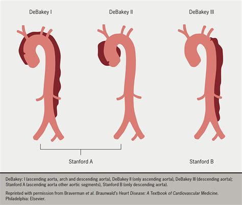 Acute aortic dissection (AAD) – a lethal disease: the epidemiology, pathophysiology and natural ...