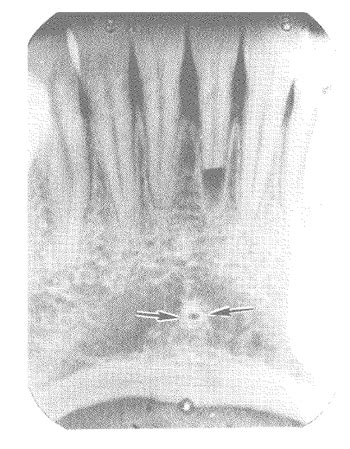 Rl On Mandibular Radiographs