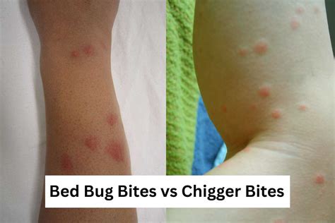 Chigger Bites vs. Bed Bug Bites: How to Tell Them Apart