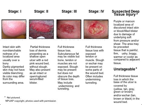 How to prevent diabetic ulcers | HubPages