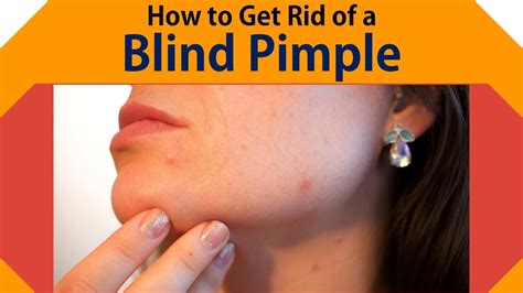 How to Get Rid of a Blind Pimple | Get Rid Blind Pimple with Warm Compress, Honey - YouTube