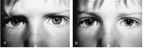 Neuro-ophthalmology Question of the Week: Physiologic Anisocoria ...