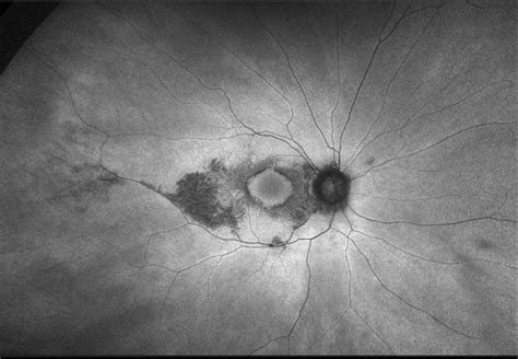 Plaquenil Toxicity - Retina Image Bank