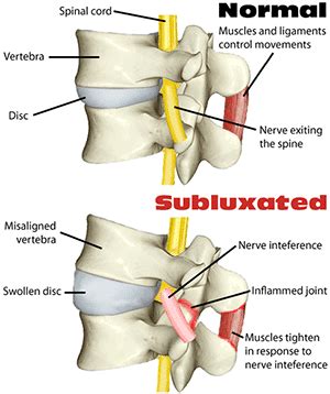 What is a Subluxation? - Altamonte Springs Chiropractor | New Patient Special