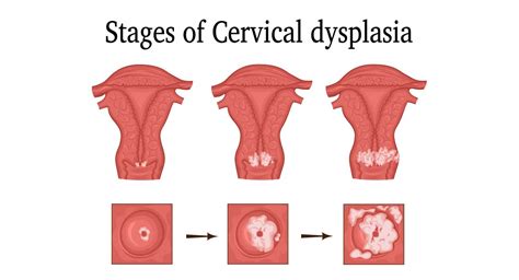 Cervical Dysplasia | Liver Doctor