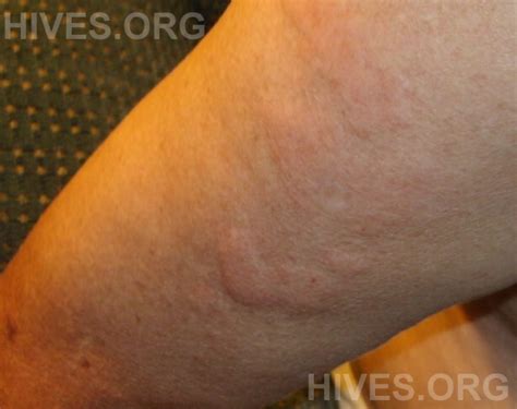 Hives Pictures - Photographs of Hives on Arms, Legs, Face, Hands, Feet ...