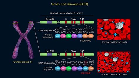 Sickle Cell Anemia Mutation