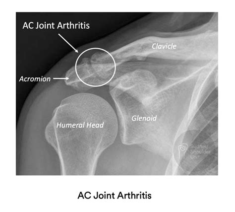 Arthroscopic AC Joint Resection | Shoulder Surgery | Sydney Shoulder Unit