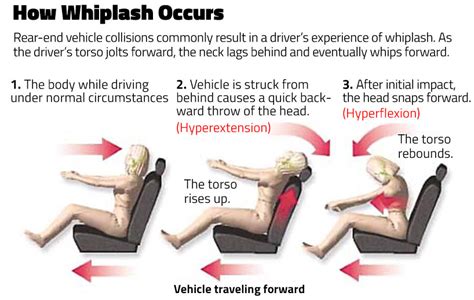 The Health Hub: Whiplash - Treatment