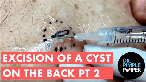 Excision of cyst on back: Part II of II. For medical education- NSFE. - Dr. Pimple Popper