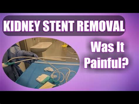 Kidney Stent Removal - Did It Hurt? (See Inside My Bladder!) - YouTube